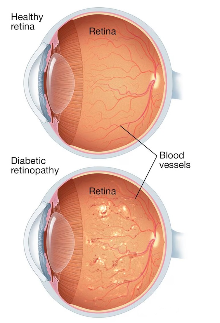 Glaucoma illustration
